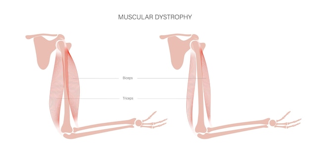 Muscular dystrophy of arm