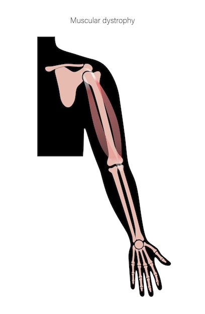 Muscular dystrophy of arm