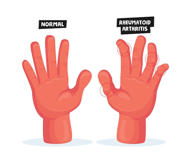 Normal and Sick Hands with Rheumatoid Arthritis