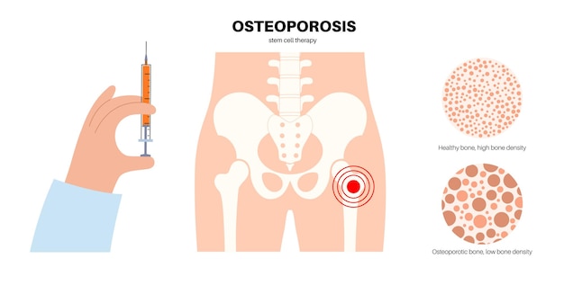 Vector osteoporosis disease stem cell treatment