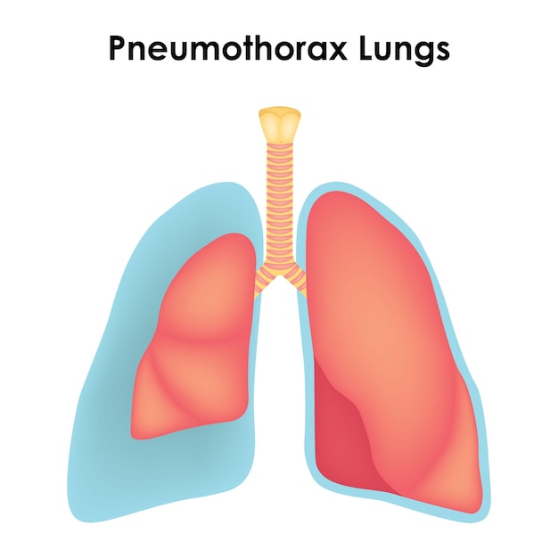 Vector pneumothorax lungs vector illustration