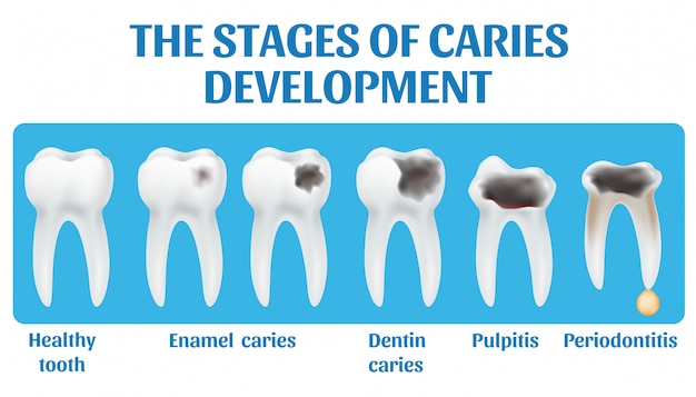 The stages of caries development.