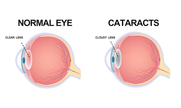 The structure of the eye. Cataract.