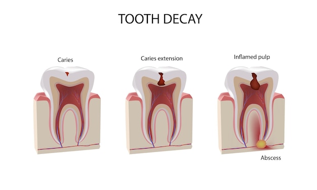 Tooth damage stages, realistic illustration