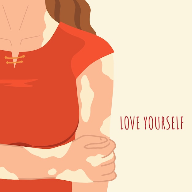 Vector illustration in a flat style. A girl with skin depigmentation. Vitiligo disease. Love yourself.