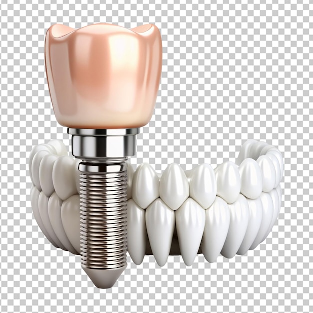 conjunto isolado de dentes brancos e implante dental em fundo transparente