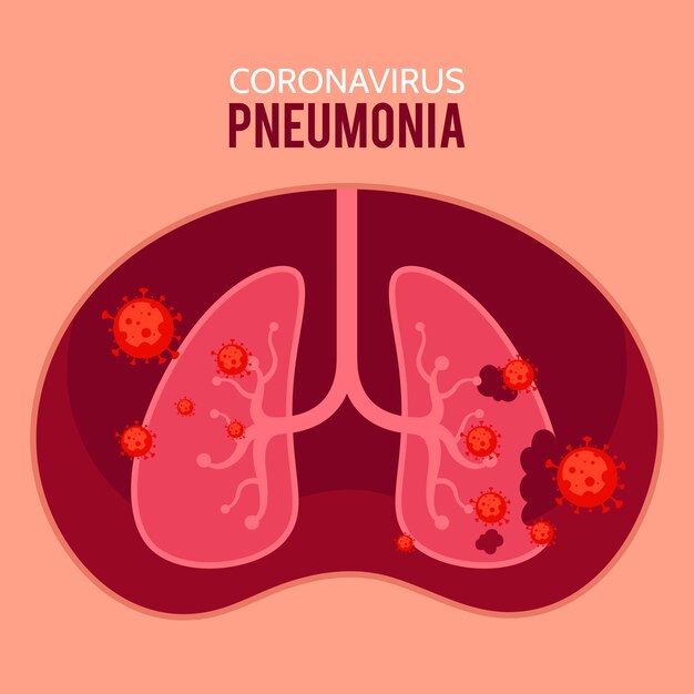 Concept de pneumonie à coronavirus