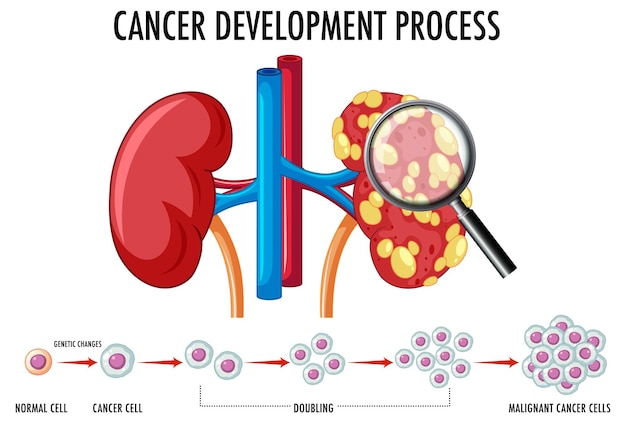 Diagramme montrant le processus de développement du cancer