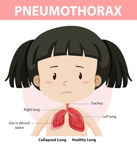 Vecteur gratuit diagramme de pneumothorax de l'anatomie humaine