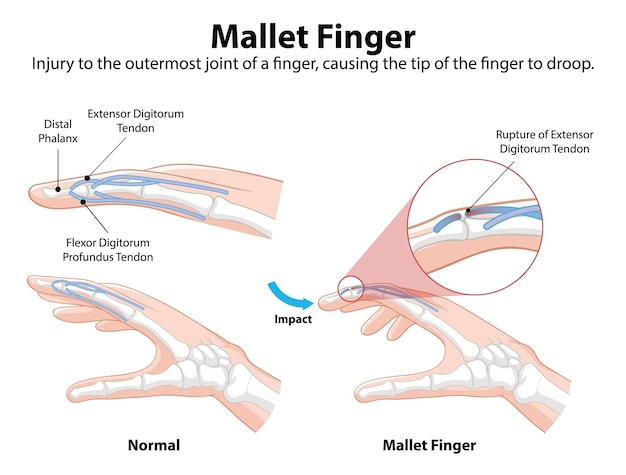 Vecteur gratuit illustration d'une blessure au doigt du marteau