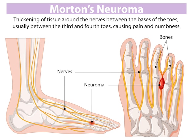 Vecteur gratuit illustration du neurome de morton