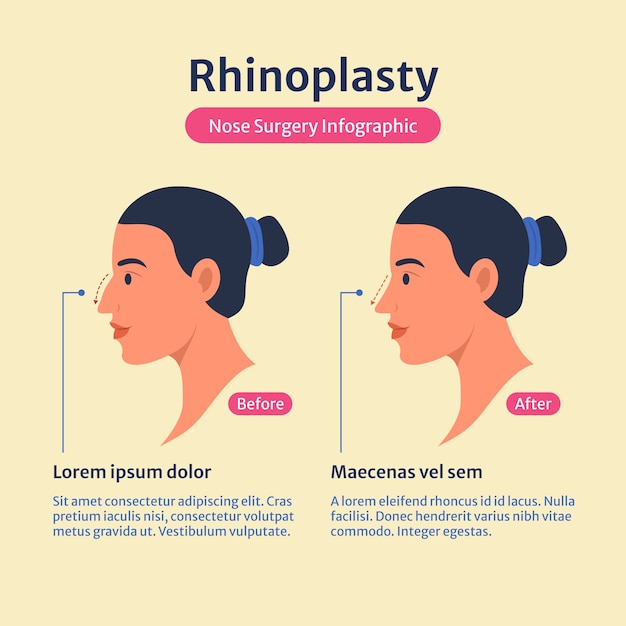 Vecteur gratuit infographie de rhinoplastie design plat dessiné à la main