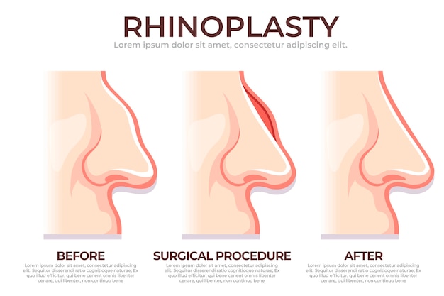 Vecteur gratuit infographie de rhinoplastie dessinée à la main