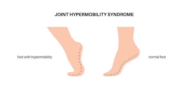 Vecteur affiche sur l'hypermobilité articulaire