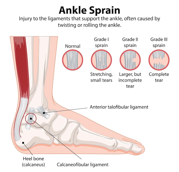 Illustration d'une blessure à la cheville