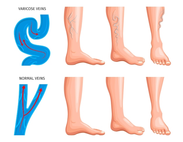 Kostenlose Vektor krampfadern anatomie realistisches set mit vergrößerungsschema von blutgefäßen in gesunden und beschädigten venen vektorgrafik