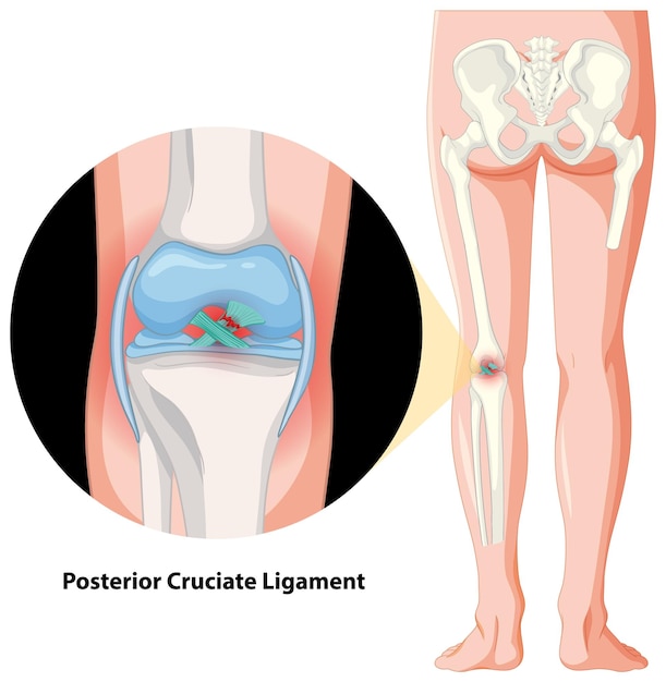 Vetor grátis anatomia do ligamento cruzado posterior