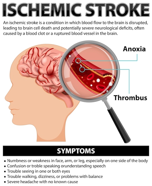 Vetor grátis cartaz informativo de avc isquêmico