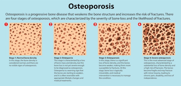 Vetor grátis densidade óssea e vetor de osteoporose