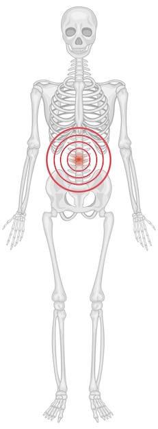 Vetor grátis esqueleto lombar sofrendo de espondilite anquilosante