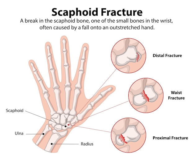 Vetor grátis ilustração da fratura do escafoide