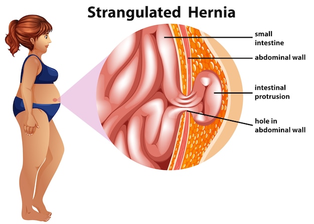 Vetor grátis infográfico de informações sobre hérnia estrangulada