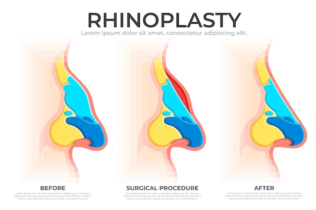 Vetor grátis infográfico de rinoplastia desenhado à mão