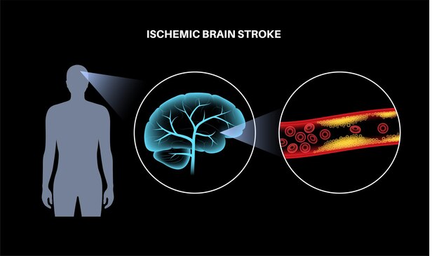 Vetor acidente vascular cerebral isêmico