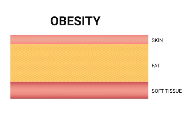 Vetor camadas de vector de ilustração de diagrama de pele em fundo branco conceito médico obesidade gordura da pele
