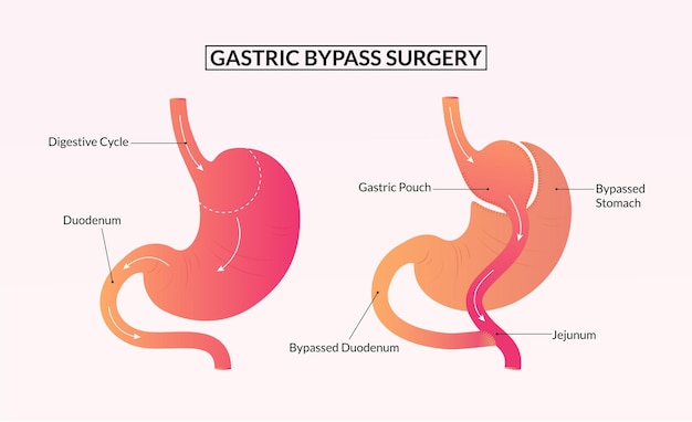 Cirurgia de bypass gástrico antes e depois da ilustração médica