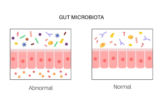 Vetor disbiose e microbiose da conexão do cérebro intestinal microbiota normal e anormal