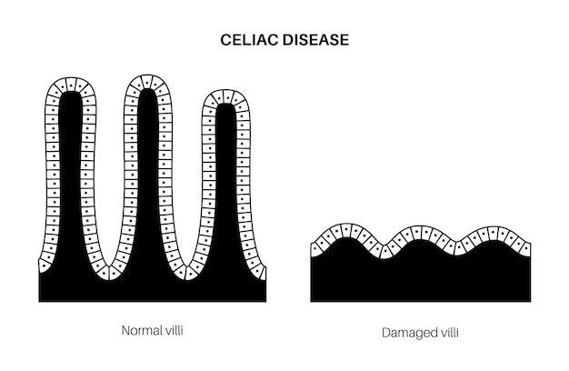 Vetor doença celíaca. vilosidades intestinais danificadas e saudáveis na área de superfície das paredes intestinais.