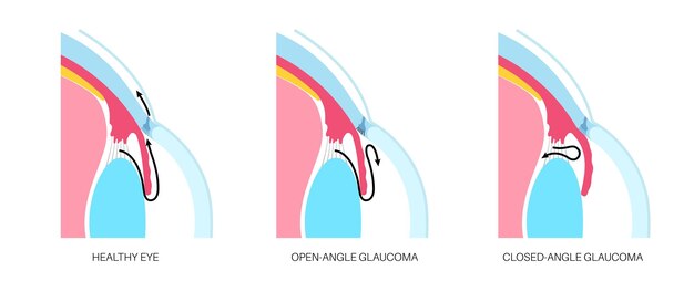 Vetor doença ocular do glaucoma