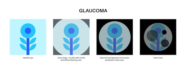 Vetor doença ocular do glaucoma