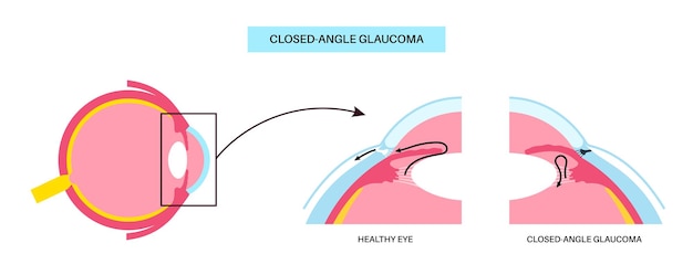 Vetor doença ocular do glaucoma