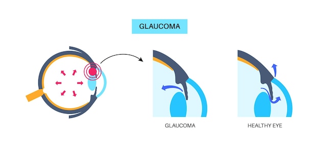 Vetor doença ocular do glaucoma