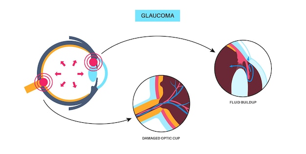 Vetor doença ocular do glaucoma