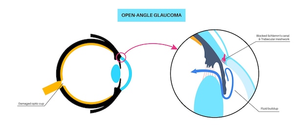 Vetor doença ocular do glaucoma