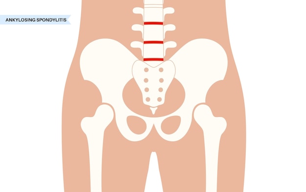 Vetor espondilite anquilosante artrite que causa inflamação nas articulações e ligamentos da coluna vértebras inflamadas e de fusão na coluna vertebral ilustração vetorial de dor no quadril e na região lombar