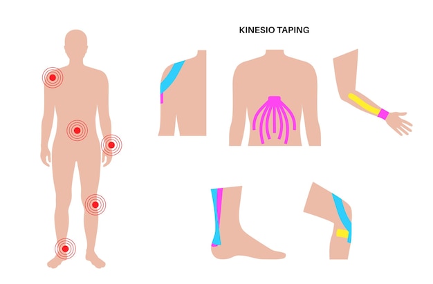 Vetor fita terapêutica elástica fita de cinesiologia no braço, perna, ombro e abdômen método kt tira elástica destinada a aliviar a dor de lesões proteção para ilustração vetorial de músculos e ligamentos