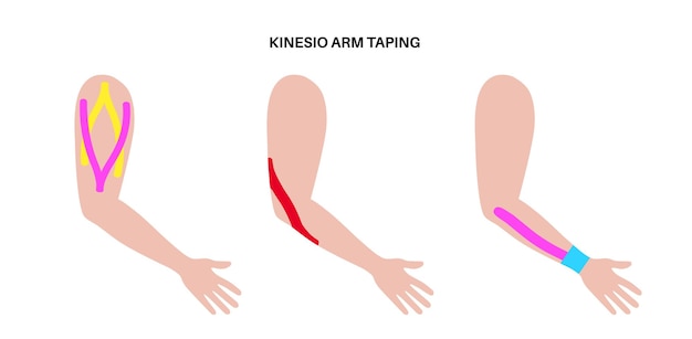 Vetor fita terapêutica elástica fita de cinesiologia no braço tira elástica do método kt destinada a aliviar a dor de lesões proteção e fixação para os músculos do cotovelo e ilustração vetorial dos ligamentos do punho