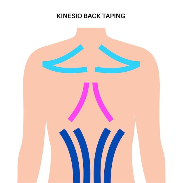 Vetor fita terapêutica elástica fita de cinesiologia nos músculos posteriores e ombros tira elástica do método kt destinada a aliviar a dor de lesões atléticas proteção para ilustração vetorial plana de ligamentos
