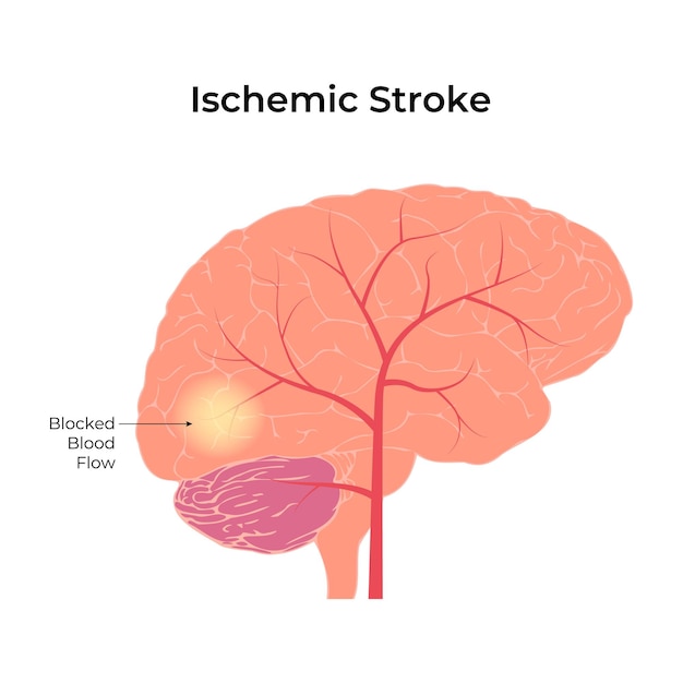 Vetor ilustração do vetor do fluxo sanguíneo bloqueado por derrame isquêmico