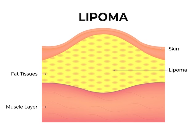 Vetor ilustração do vetor do lipoma