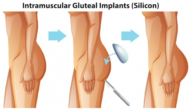 Vetor implantes glúteos intramusculares em fundo branco