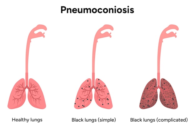 Vetor pneumoconiose pulmões saudáveis e pretos