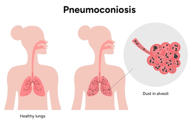 Vetor pneumoconiose pulmões saudáveis e pretos