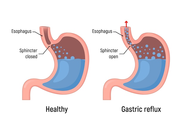 Refluxo gástrico esofágico indigestão ácida Estômago gastrintestinal azia DRGE refluxo gástrico