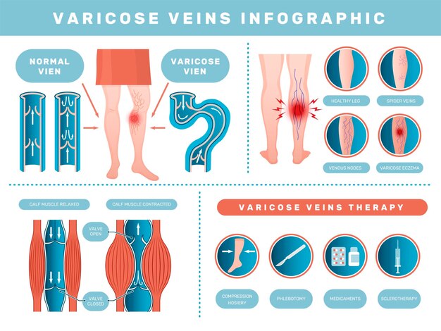 Vetor varicose infográfico doença venosa problemas de saúde médica com sangue humano veno recente conjunto de modelos de vetores de trombose do corpo de saúde e ilustração de tratamento