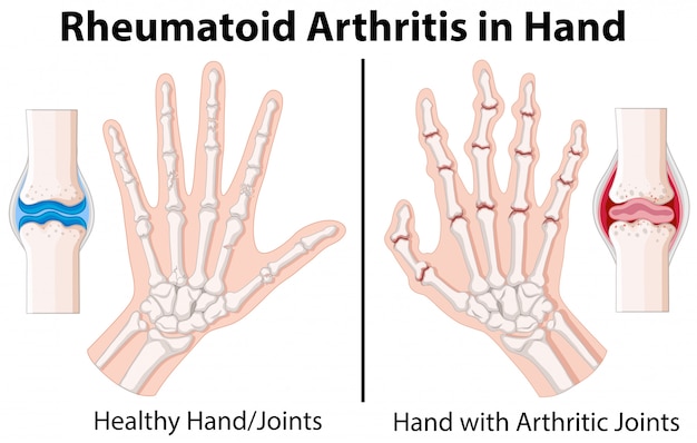 Diagramma che mostra l&#39;artrite reumatoide in mano